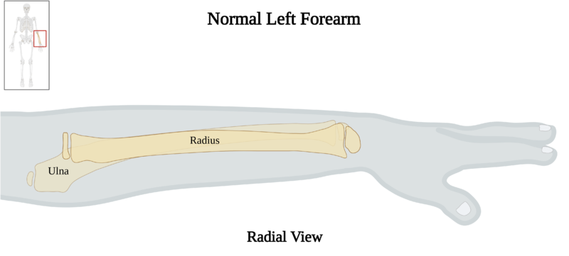 File:Normal Left Forearm of 10 y.o. Female - Radial View.png