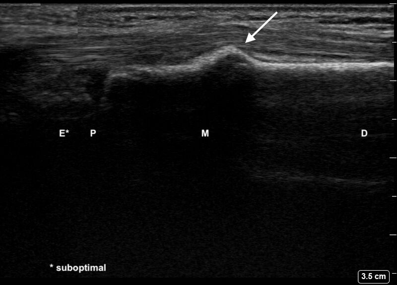 File:Ultrasound Labelled Scan - Lateral Radius View - 12-Year-Old Male Patient with Buckle Fracture.jpg