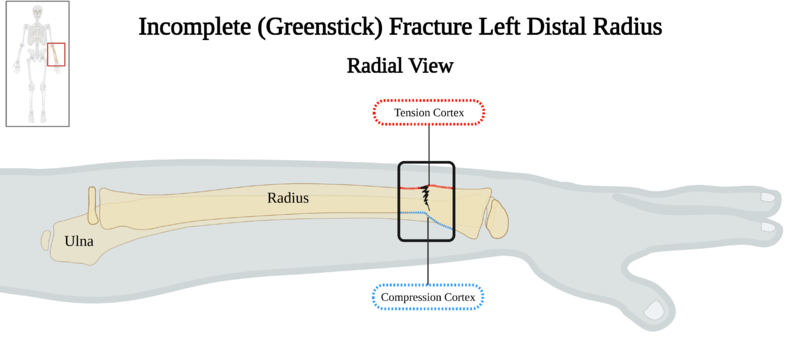 File:Greenstick Fracture Left Distal Radius - Radial View v3.0.png