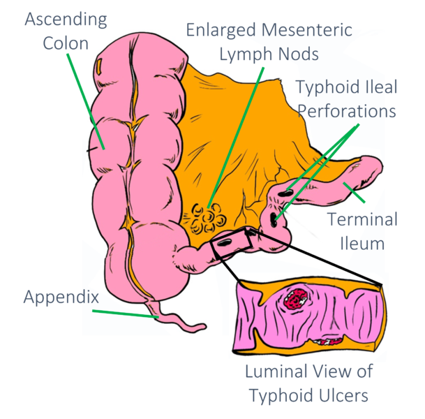 File:Typhoid Ulcers.png