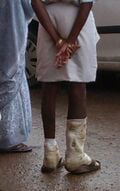 Medical dressing of both legs moist due to lose of skin by Diabetic Gangerene. Right click to enlarge picture in new window.