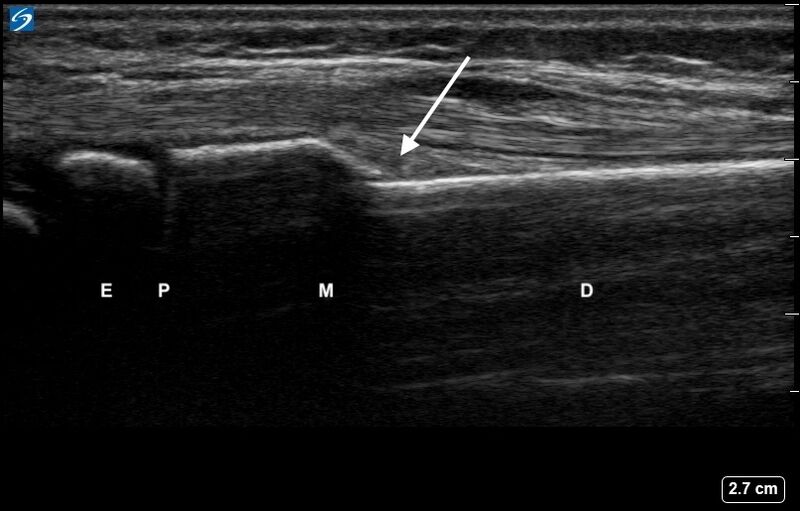 File:Ultrasound Labelled Scan - Dorsal Radial View - 6-Year-Old Female Patient with Cortical Break Fracture of Radius.jpg