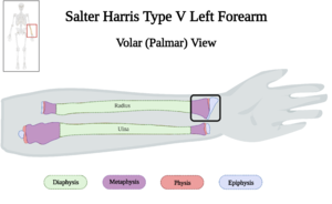 Salter-Harris Type V Fracture of Left Forearm of 10 y.o. Female v4.0.png