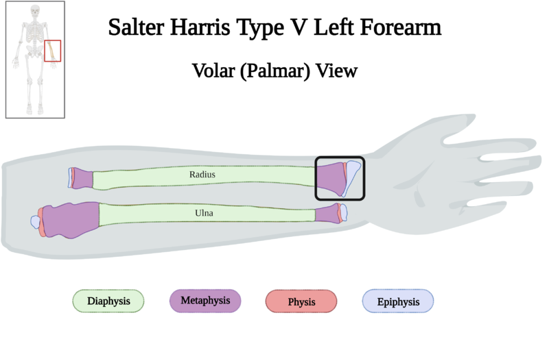 File:Salter-Harris Type V Fracture of Left Forearm of 10 y.o. Female v4.0.png