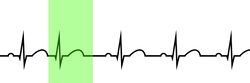 Figure 2. Sinus rhythm with a highlighted premature junctional contraction (PJC).