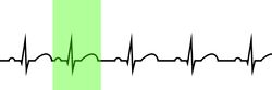 Figure 1. Sinus rhythm with a highlighted premature atrial contraction (PAC).