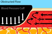 Fig. 3: An artery with a blood pressure cuff where the cuff pressure is greater than the systolic blood pressure.