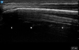 Ultrasound Labelled Scan - Dorsal Ulna - Healthy Adult.jpg.jpg
