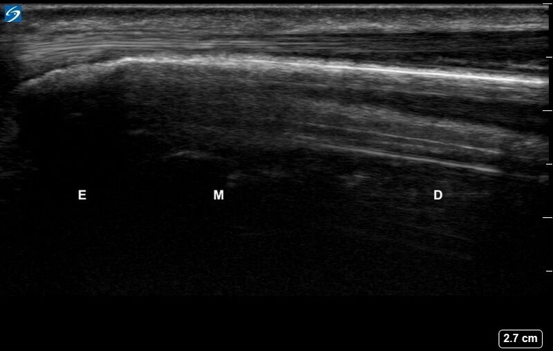 File:Ultrasound Labelled Scan - Dorsal Ulna - Healthy Adult.jpg.jpg