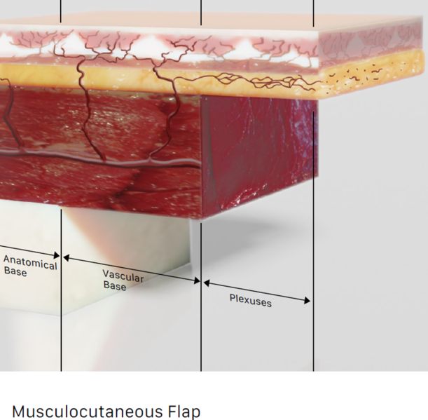 File:Musculocutaneous Flap Diagram.png