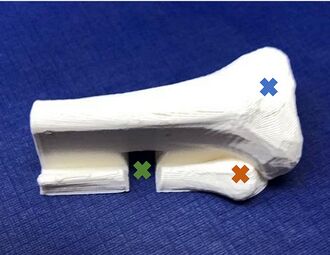 A printed white PLA infant tibia fragment on a blue cloth, seen from the side, with coloured X marks on the tibial head, the fibular head and the groove between them; the open end shows a thin hollow shell.