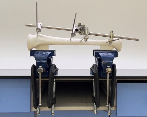 Modular External Fixation for an Open Tibial Shaft Transverse Fracture