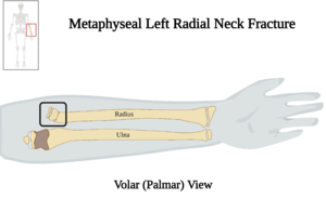 Left Proximal Radius Fracture - Volar View v2.0.png