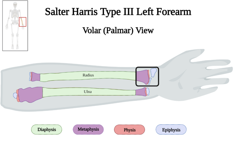 File:Salter-Harris Type III Fracture of Left Forearm of 10 y.o. Female v4.0.png
