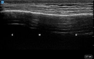 Ultrasound Labelled Scan - Lateral Radius - Healthy Adult.jpg.jpg