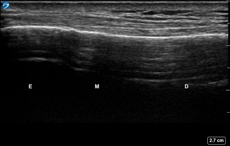 File:Ultrasound Labelled Scan - Lateral Radius - Healthy Adult.jpg.jpg