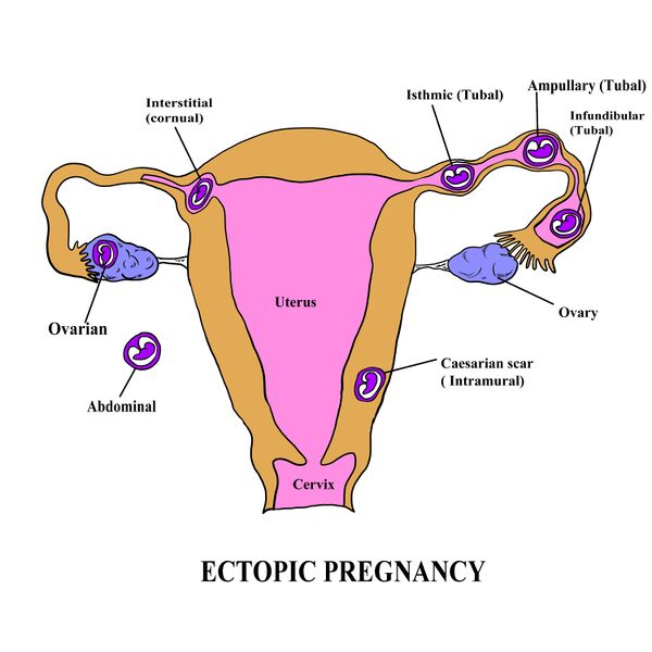 File:ECTOPIC PREGNANCY.jpg