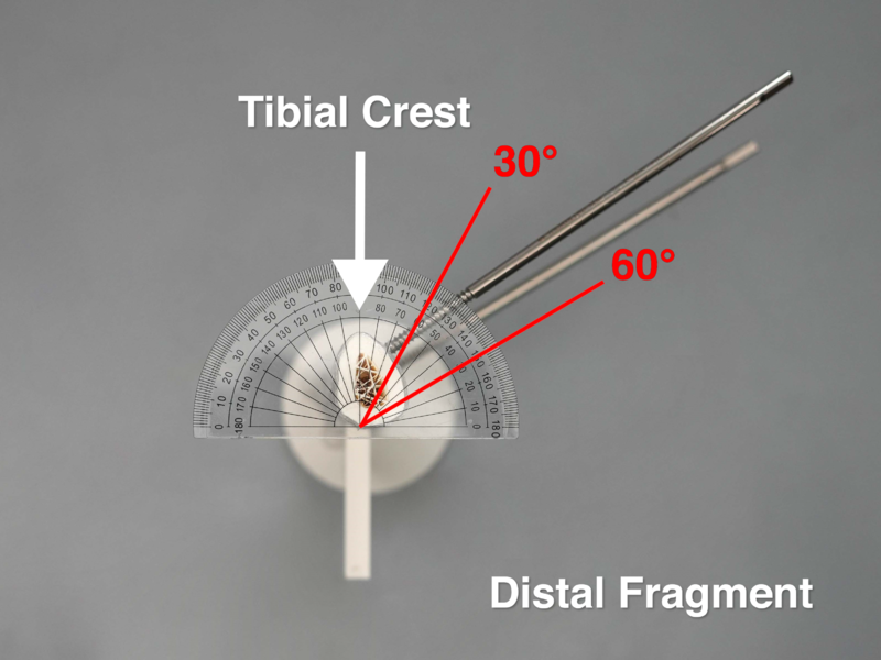 File:Cross-Section View of Distal Fragment -Uniplanar External Fixation v2.0.png