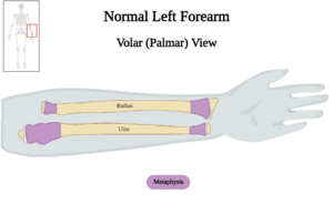 Normal Left Forearm of 10 y.o. Female - Metaphysis v2.0.png