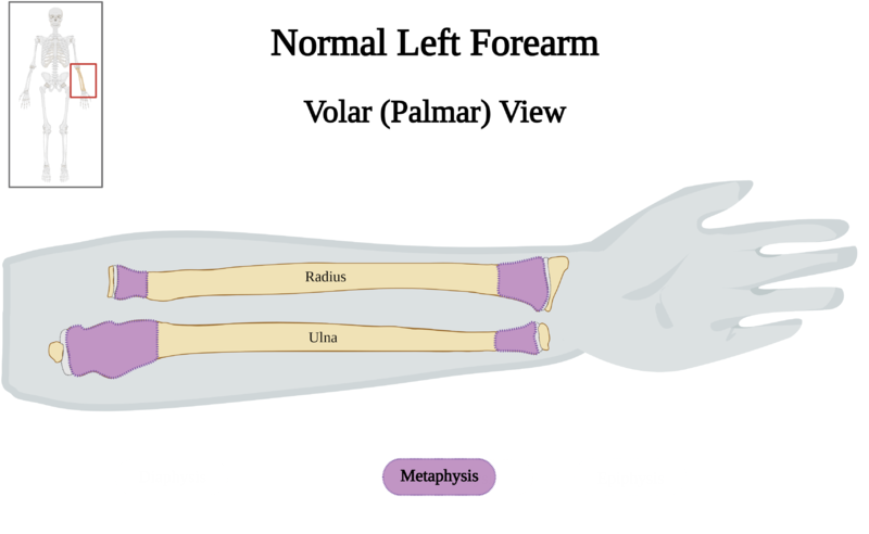 File:Normal Left Forearm of 10 y.o. Female - Metaphysis v2.0.png