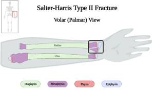 Salter-Harris Type II Fracture of Left Forearm of 10 y.o. Female v4.0.png