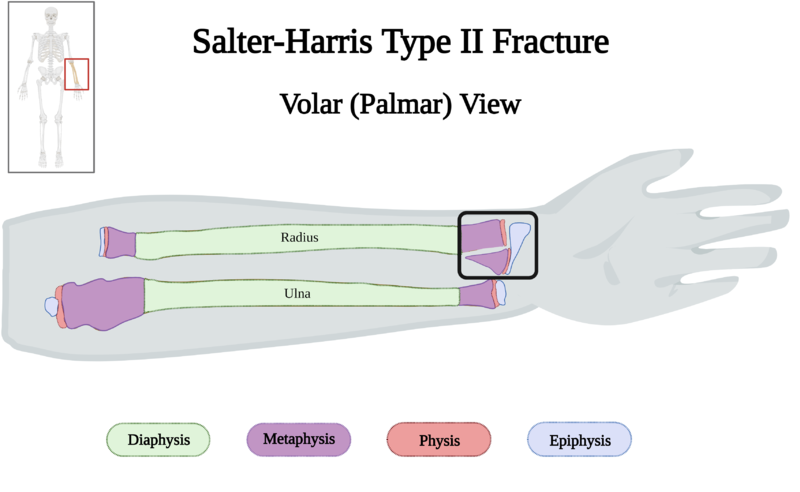 File:Salter-Harris Type II Fracture of Left Forearm of 10 y.o. Female v4.0.png