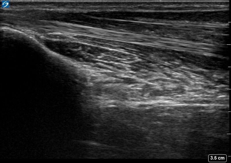 File:Ultrasound Scan - Pronator Quadratus Sweep of Ipsilateral Forearm - Healthy Adult.jpg