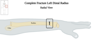 Complete Fracture Left Distal Radius - Radial View.png