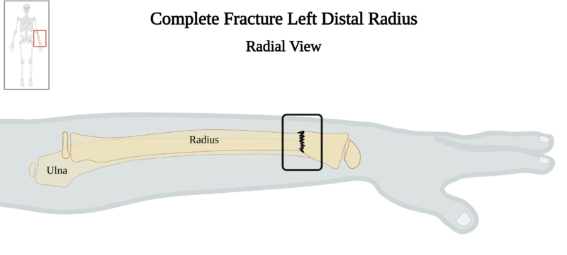 File:Complete Fracture Left Distal Radius - Radial View.png