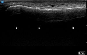 Ultrasound Labelled Scan - Lateral Ulna - Healthy Adult.jpg.jpg