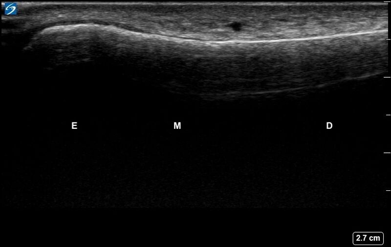 File:Ultrasound Labelled Scan - Lateral Ulna - Healthy Adult.jpg.jpg