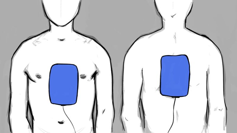 File:EMS pediatric AED pad placement.jpg
