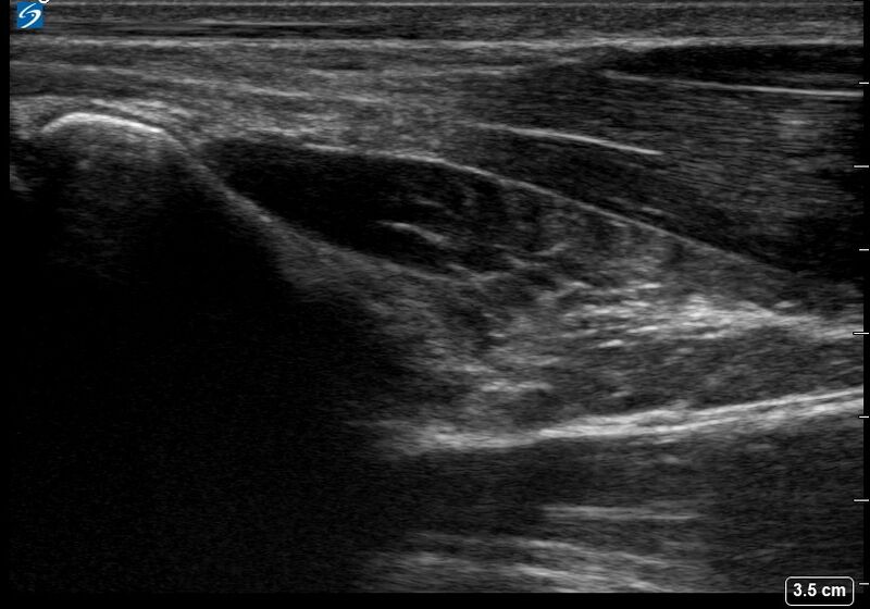 File:Ultrasound Labelled Scan - Pronator Quadratus Muscle - Healthy Adult.jpg