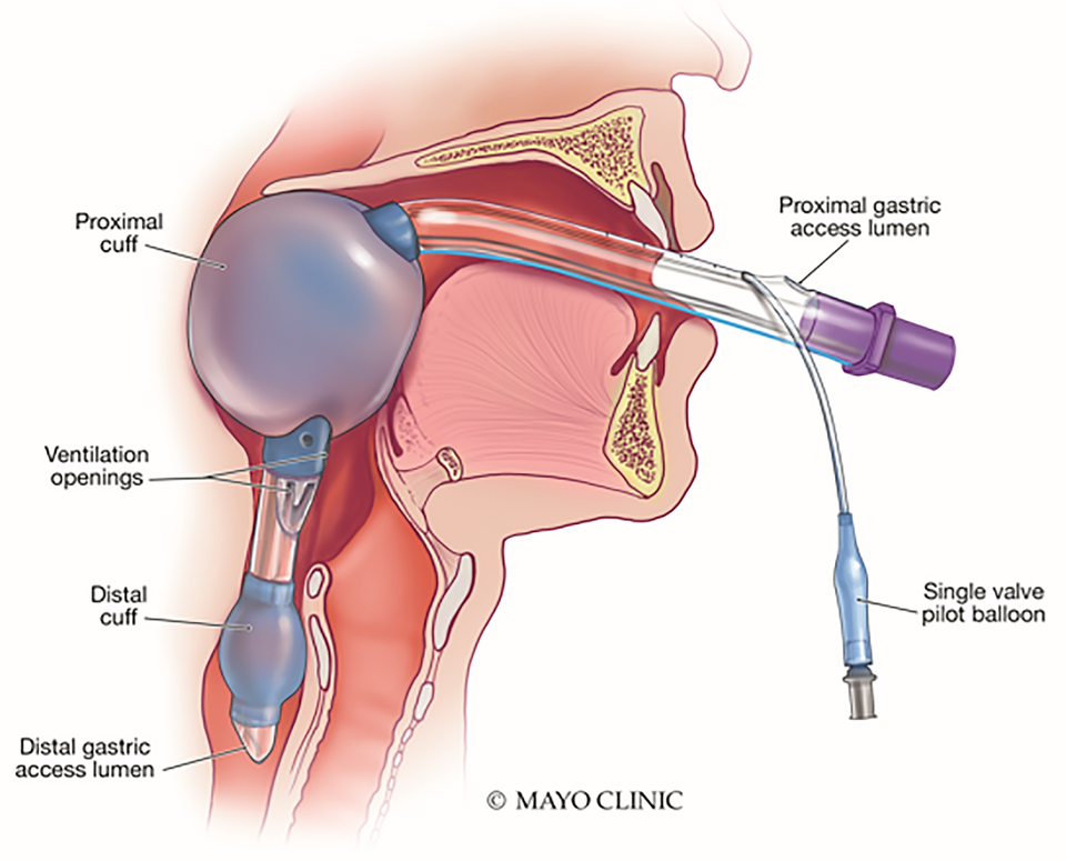 File:FCEMT-King Tube.png