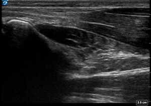 Ultrasound Scan - Pronator Quadratus Sweep of Contralateral Forearm - Healthy Adult.jpg