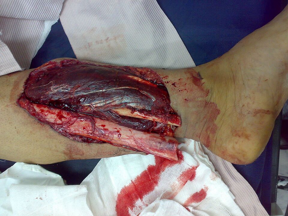 File:Open fracture.jpg