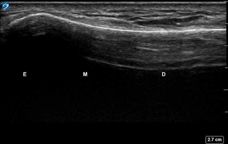 File:Ultrasound Labelled Scan - Dorsal Radius - Healthy Adult.jpg