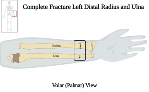 Complete Fracture Left Distal Radius and Ulna - Volar View.png