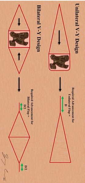 330px-V-Y_Uni_vs_Bi.jpg