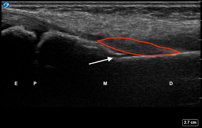 File:Ultrasound Labelled Scan - Periosteal Hematoma of Pediatric Distal Forearm Fracture v3.0.jpg