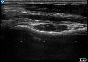 Ultrasound Labelled Scan - Volar Ulna - Healthy Adult.jpg.jpg