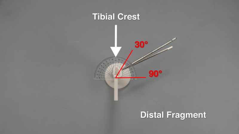 File:Cross-Section View Photo of Drill Trajectory Angles of Schanz Screws in Distal Fragment v5.0.png
