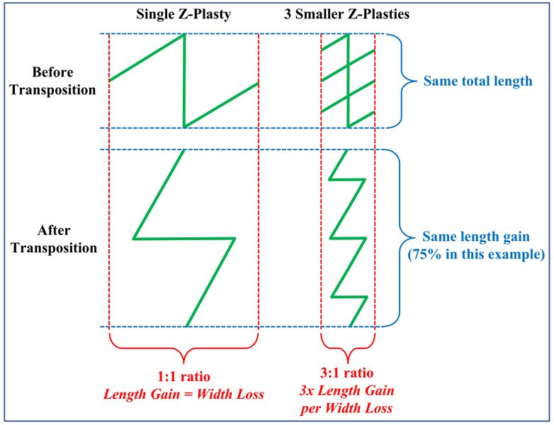 File:Single vs Multiple Z-Plasty Comparison.jpg