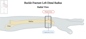 Buckle Fracture Left Distal Radius - Radial View.png