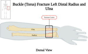 Buckle Fracture Left Distal Radius and Ulna - Dorsal View.png